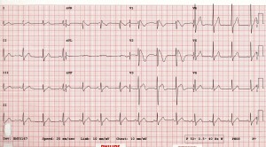 Sindrome di Brugada, rilevabile sono all' ECG